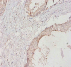 Immunohistochemistry of paraffin-embedded human prostate tissue using YWHAH Antibody at dilution of 1:20Rabbit anti-Human YWHAH Polyclonal Antibody