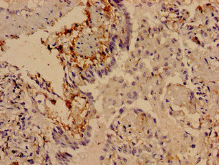 Immunocytochemistry analysis of human lung cancer using SLITRK5 Antibody at dilution of 1:100