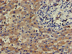 Immunohistochemistry of paraffin-embedded human liver cancer using SLU7 Antibody at dilution of 1:100Rabbit anti-Human SLU7 Polyclonal Antibody