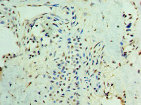 Immunohistochemistry of paraffin-embedded human breast cancer using SMAD3 Antibody at dilution of 1:100Rabbit anti-Human SMAD3 Polyclonal Antibody