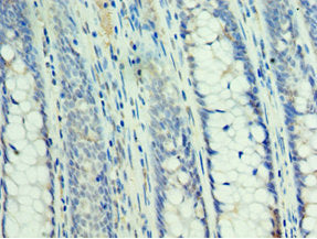 Immunohistochemistry of paraffin-embedded human colon cancer using SMAD3 Antibody at dilution of 1:100Rabbit anti-Human SMAD3 Polyclonal Antibody
