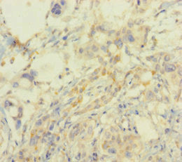 Immunohistochemistry of paraffin-embedded human pancreatic cancer using SMARCA2 Antibody at dilution of 1:100Rabbit anti-Human SMARCA2 Polyclonal Antibody