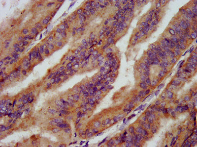 IHC image of the antibody diluted at 1:200 and staining in paraffin-embedded human endometrial cancer performed on a Leica BondTM system. After dewaxing and hydration, antigen retrieval was mediated by high pressure in a citrate buffer (pH 6.0). Section was blocked with 10% normal goat serum 30min at RT. Then primary antibody (1% BSA) was incubated at 4°C overnight. The primary is detected by a biotinylated secondary antibody and visualized using an HRP conjugated SP system.Rabbit anti-Human SMPD2 Polyclonal Antibody