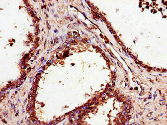 Immunohistochemistry of paraffin-embedded human prostate cancer using the antibody at dilution of 1:100Rabbit anti-Human SMS Polyclonal Antibody