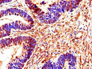 Immunohistochemistry of paraffin-embedded human ovarian cancer using SMS Antibody at dilution of 1:100Rabbit anti-Human SMS Polyclonal Antibody