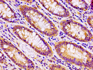 IHC image of the antibody diluted at 1:100 and staining in paraffin-embedded human colon cancer performed on a Leica BondTM system. After dewaxing and hydration, antigen retrieval was mediated by high pressure in a citrate buffer (pH 6.0). Section was blocked with 10% normal goat serum 30min at RT. Then primary antibody (1% BSA) was incubated at 4°C overnight. The primary is detected by a biotinylated secondary antibody and visualized using an HRP conjugated SP system.Rabbit anti-Human SNAP23 Polyclonal Antibody
