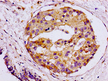 IHC image of SNAP23 Antibody diluted at 1:100 and staining in paraffin-embedded human breast cancer performed on a Leica BondTM system. After dewaxing and hydration, antigen retrieval was mediated by high pressure in a citrate buffer (pH 6.0). Section was blocked with 10% normal goat serum 30min at RT. Then primary antibody (1% BSA) was incubated at 4°C overnight. The primary is detected by a biotinylated secondary antibody and visualized using an HRP conjugated ABC system.Rabbit anti-Human SNAP23 Polyclonal Antibody