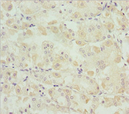 Immunohistochemistry of paraffin-embedded human gastric cancer using SNAP29 Antibody at dilution of 1:100Rabbit anti-Human SNAP29 Polyclonal Antibody