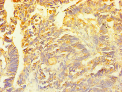 Immunohistochemistry of paraffin-embedded human ovarian cancer using SNCG Antibody at dilution of 1:100Rabbit anti-Human SNCG Polyclonal Antibody