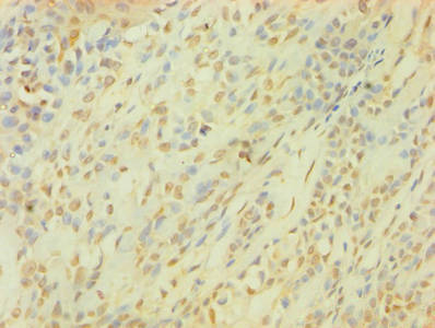 Immunohistochemistry of paraffin-embedded human breast cancer using SNCG Antibody at dilution of 1:100Rabbit anti-Human SNCG Polyclonal Antibody