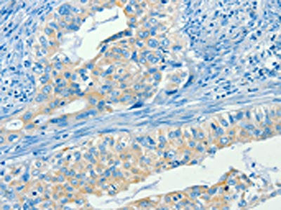 The image on the left is immunohistochemistry of paraffin-embedded Human cervical cancer tissue using the antibody Antibody) at dilution 1/60, on the right is treated with synthetic peptide. (Original magnification: ×200)Rabbit anti-Human SERPINA9 Polyclonal Antibody