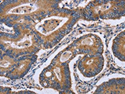 The image is immunohistochemistry of paraffin-embedded Human colon cancer tissue using the antibody Antibody) at dilution 1/30. (Original magnification: ×200)Rabbit anti-Human GABPB2 Polyclonal Antibody