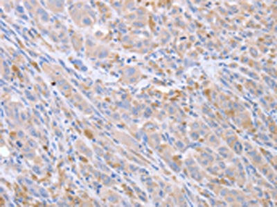 The image on the left is immunohistochemistry of paraffin-embedded Human lung cancer tissue using ACTL8 Antibody(ACTL8 Antibody) at dilution 1/15, on the right is treated with fusion protein. (Original magnification: ×200)