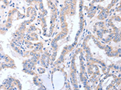 The image on the left is immunohistochemistry of paraffin-embedded Human thyroid cancer tissue using the antibody Antibody) at dilution 1/15, on the right is treated with fusion protein. (Original magnification: ×200)