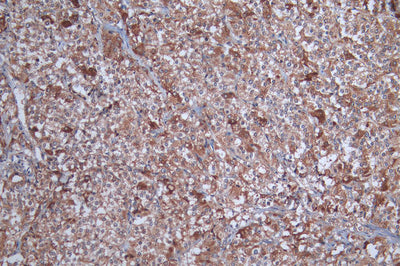 IHC image of the antibody diluted at 1:100 and staining in paraffin-embedded human adrenal gland tissueperformed on a Leica BondTM system. After dewaxing and hydration, antigen retrieval was mediated by high pressure in a citrate buffer (pH 6.0). Section was blocked with 10% normal goat serum 30min at RT. Then primary antibody (1% BSA) was incubated at 4°C overnight. The primary is detected by a Goat anti-rabbit polymer IgG labeled by HRP and visualized using 0.05% DAB.Rabbit anti-Human SOAT1 Polyclonal Antibody