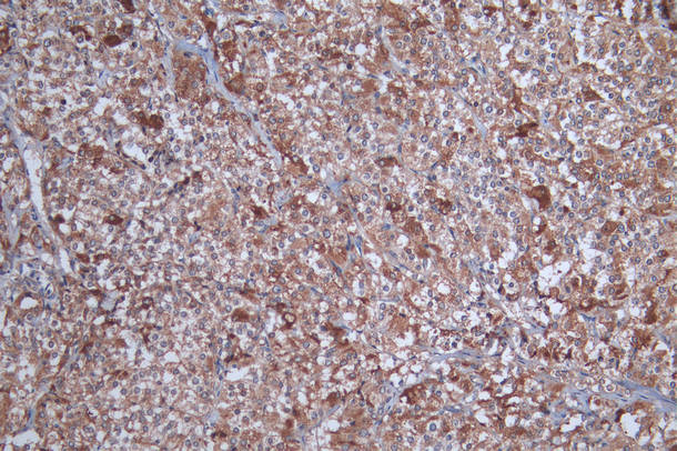 IHC image of the antibody diluted at 1:100 and staining in paraffin-embedded human adrenal gland tissueperformed on a Leica BondTM system. After dewaxing and hydration, antigen retrieval was mediated by high pressure in a citrate buffer (pH 6.0). Section was blocked with 10% normal goat serum 30min at RT. Then primary antibody (1% BSA) was incubated at 4°C overnight. The primary is detected by a Goat anti-rabbit polymer IgG labeled by HRP and visualized using 0.05% DAB.Rabbit anti-Human SOAT1 Polyclonal Antibody