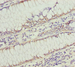 Immunohistochemistry of paraffin-embedded human colon cancer using SOCS4 Antibody at dilution of 1:100Rabbit anti-Human SOCS4 Polyclonal Antibody