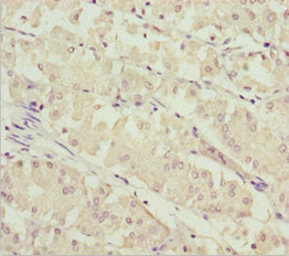 Immunohistochemistry of paraffin-embedded human gastric cancer using SOCS4 Antibody at dilution of 1:100Rabbit anti-Human SOCS4 Polyclonal Antibody