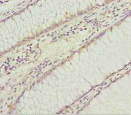 Immunohistochemistry of paraffin-embedded human colon cancer using SOCS4 Antibody at dilution of 1:100Rabbit anti-Human SOCS4 Polyclonal Antibody