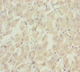 Immunohistochemistry of paraffin-embedded human gastric cancer using SOCS4 Antibody at dilution of 1:100Rabbit anti-Human SOCS4 Polyclonal Antibody