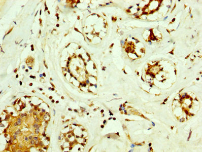 IHC image of SOD2 Antibody diluted at 1:560 and staining in paraffin-embedded human breast cancer performed on a Leica BondTM system. After dewaxing and hydration, antigen retrieval was mediated by high pressure in a citrate buffer (pH 6.0). Section was blocked with 10% normal goat serum 30min at RT. Then primary antibody (1% BSA) was incubated at 4°C overnight. The primary is detected by a biotinylated secondary antibody and visualized using an HRP conjugated SP system.Rabbit anti-Human SOD2 Polyclonal Antibody