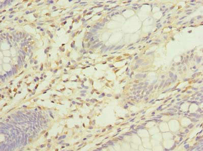 Immunohistochemistry of paraffin-embedded human colon cancer using SORBS3 Antibody at dilution of 1:100Rabbit anti-Human SORBS3 Polyclonal Antibody