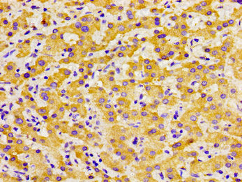 Immunohistochemistry of paraffin-embedded human liver cancer using SOX11 Antibody at dilution of 1:100Rabbit anti-Human SOX11 Polyclonal Antibody