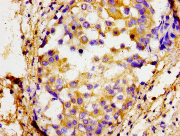 Immunohistochemistry of paraffin-embedded human breast cancer using SOX11 Antibody at dilution of 1:100Rabbit anti-Human SOX11 Polyclonal Antibody