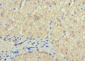 Immunohistochemistry of paraffin-embedded human liver cancer using SOX14 Antibody at dilution of 1:100Rabbit anti-Human SOX14 Polyclonal Antibody