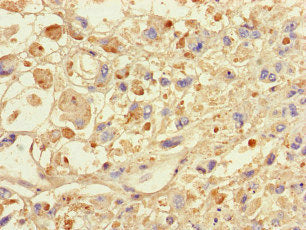 Immunohistochemistry of paraffin-embedded human melanoma using the antibody at dilution of 1:100