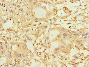 Immunohistochemistry of paraffin-embedded human pancreatic cancer using SPAG9 Antibody at dilution of 1:100
