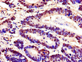 Immunohistochemistry of paraffin-embedded human colon cancer using SPDEF Antibody at dilution of 1:100Rabbit anti-Human SPDEF Polyclonal Antibody