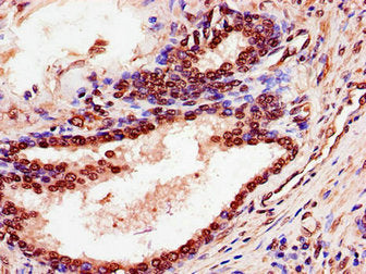 Immunohistochemistry of paraffin-embedded human prostate cancer using SPDEF Antibody at dilution of 1:100Rabbit anti-Human SPDEF Polyclonal Antibody