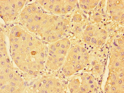 Immunohistochemistry of paraffin-embedded human liver cancer using SPHK1 Antibody at dilution of 1:100Rabbit anti-Human SPHK1 Polyclonal Antibody