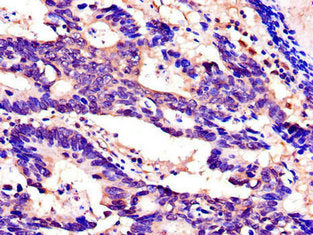 Immunohistochemistry of paraffin-embedded human colon cancer using SPINK1 Antibody at dilution of 1:100Rabbit anti-Human SPINK1 Polyclonal Antibody