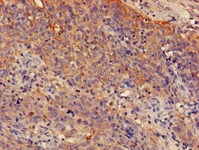 Immunohistochemistry of paraffin-embedded human cervical cancer using the antibody at dilution of 1:100Rabbit anti-Human SPRR1A Polyclonal Antibody