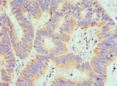 Immunohistochemistry of paraffin-embedded human colon cancer using SPTLC1 Antibody at dilution of 1:100Rabbit anti-Human SPTLC1 Polyclonal Antibody