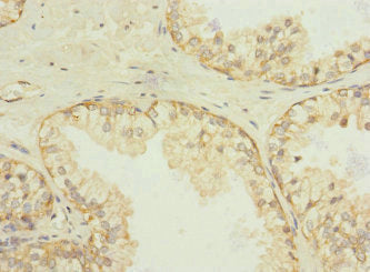 Immunohistochemistry of paraffin-embedded human prostate cancer using SQOR Antibody at dilution of 1:100Rabbit anti-Human SQOR Polyclonal Antibody