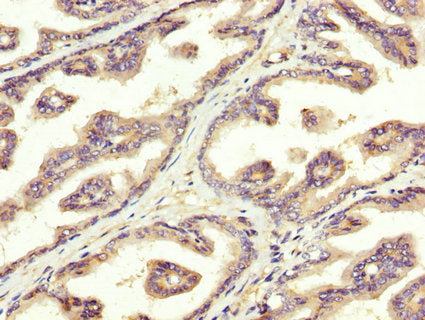 IHC image of SREBF1 Antibody diluted at 1:300 and staining in paraffin-embedded human prostate tissue performed on a Leica BondTM system. After dewaxing and hydration, antigen retrieval was mediated by high pressure in a citrate buffer (pH 6.0). Section was blocked with 10% normal goat serum 30min at RT. Then primary antibody (1% BSA) was incubated at 4°C overnight. The primary is detected by a biotinylated secondary antibody and visualized using an HRP conjugated SP system.Rabbit anti-Human SREBF1 Polyclonal Antibody