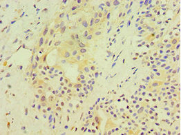 Immunohistochemistry of paraffin-embedded human breast cancer using SRM Antibody at dilution of 1:100Rabbit anti-Human SRM Polyclonal Antibody
