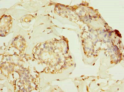 Immunohistochemistry of paraffin-embedded human breast cancer using HPCAL1 Antibody at dilution of 1:100Rabbit anti-Human HPCAL1 Polyclonal Antibody