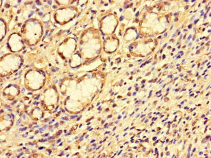 Immunohistochemistry of paraffin-embedded human gastric cancer using SS18L1 Antibody at dilution of 1:100Rabbit anti-Human SS18L1 Polyclonal Antibody