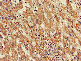 Immunohistochemistry of paraffin-embedded human liver cancer using ST8SIA5 Antibody at dilution of 1:100Rabbit anti-Human ST8SIA5 Polyclonal Antibody