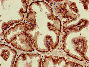 Immunohistochemistry of paraffin-embedded human prostate cancer using ST8SIA5 Antibody at dilution of 1:100Rabbit anti-Human ST8SIA5 Polyclonal Antibody