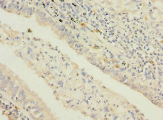 Immunohistochemistry of paraffin-embedded human lung cancer using STAM2 Antibody at dilution of 1:100Rabbit anti-Human STAM2 Polyclonal Antibody