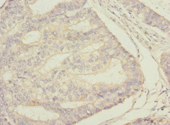 Immunohistochemistry of paraffin-embedded human endometrial cancer using STAM2 Antibody at dilution of 1:100Rabbit anti-Human STAM2 Polyclonal Antibody