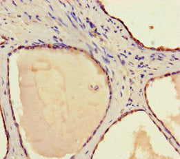 Immunohistochemistry of paraffin-embedded human prostate cancer using STAMBP Antibody at dilution of 1:100Rabbit anti-Human STAMBP Polyclonal Antibody