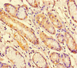 Immunohistochemistry of paraffin-embedded human gastric cancer using the antibody at dilution of 1:100Rabbit anti-Human STAT1 Polyclonal Antibody