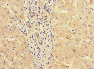 Immunohistochemistry of paraffin-embedded human liver tissue using the antibody at dilution of 1:100Rabbit anti-Human STAT3 Polyclonal Antibody