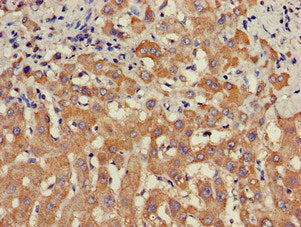 Immunohistochemistry of paraffin-embedded human liver cancer using STAT4 Antibody at dilution of 1:100Rabbit anti-Human STAT4 Polyclonal Antibody